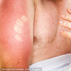 8 tips to heal sunburn fast